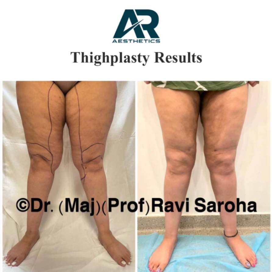 Thighplasty Before and After