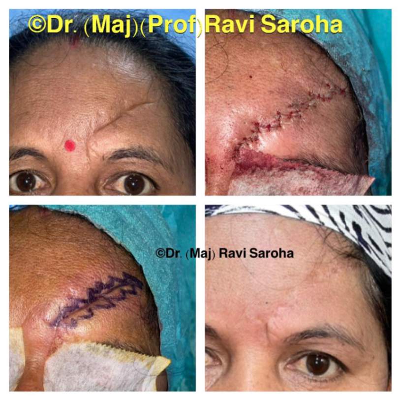 Scar Revision Before and After