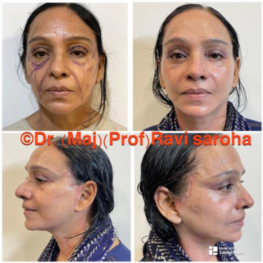 Facelift Before and After