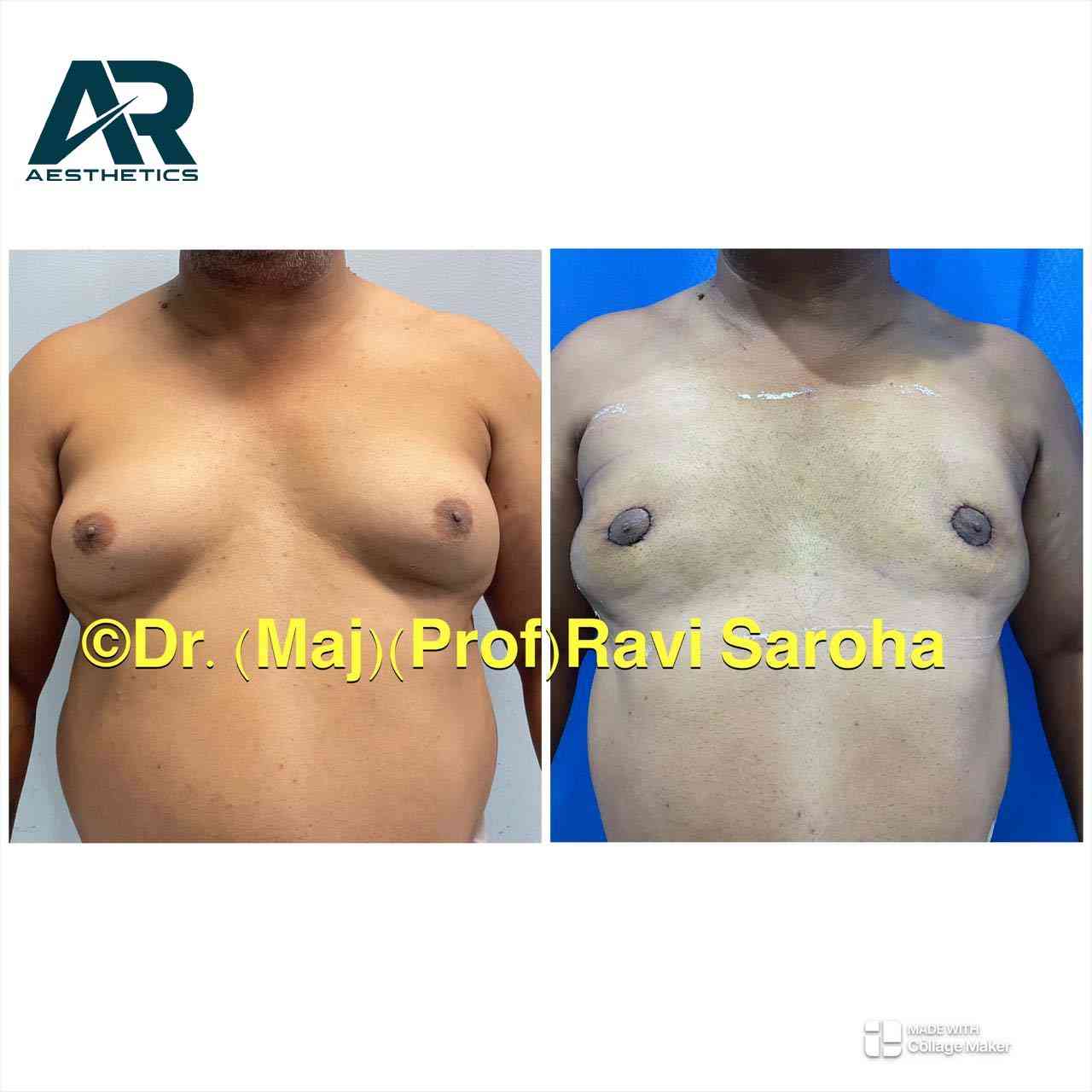 Gynecomastia