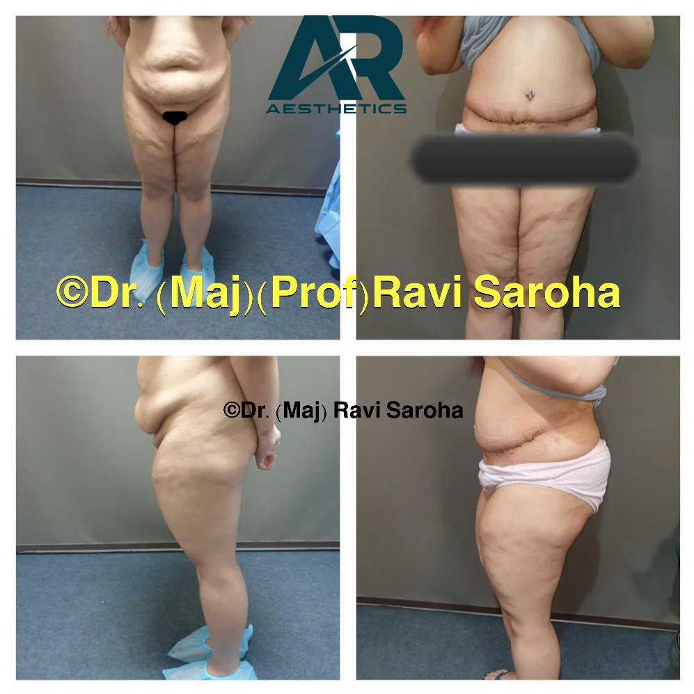 Abdominoplasty before and after