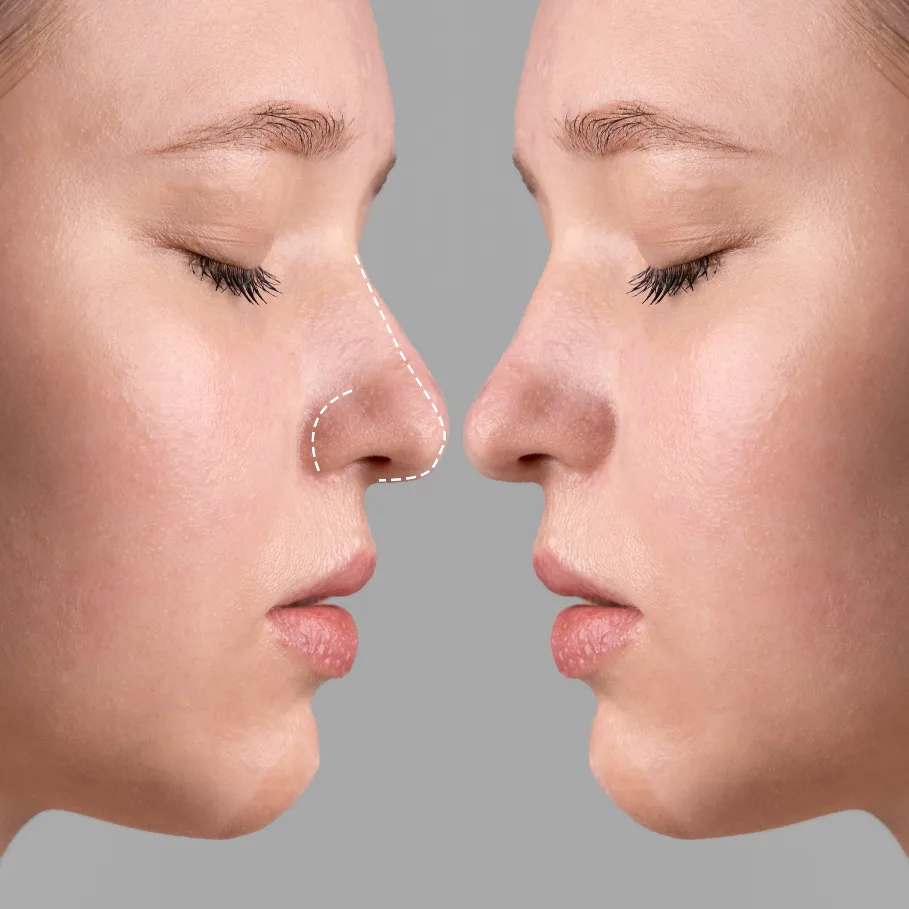 Rhinoplasty